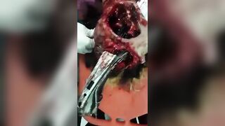 Man's Skull Completely Dismembered With Metal Rod