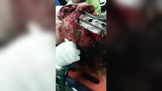 Man's Skull Completely Dismembered With Metal Rod
