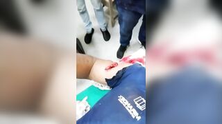 Work Injury Glass Cutting Aorta Version [Action & AF