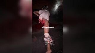 The Accident Resulted In The Man's Leg Being Completely Destroyed