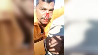 Man Loses Nose In Motorcycle Accident