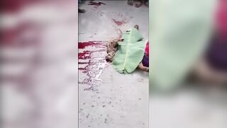 A Woman's Skull Was Ejected From Her Skin In An Accident. India "