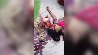 A Woman's Skull Was Ejected From Her Skin In An Accident. India "