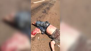 Motorcyclist Dies, Leg Amputated 