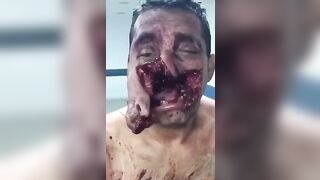 Man's Face Mutilated By A Tree 