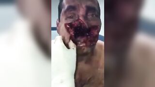 Man's Face Mutilated By A Tree 