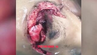 Severe Chest Injury 