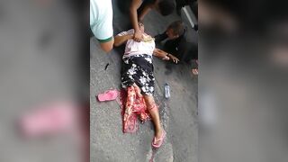Woman Breaks Leg 