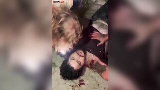 The Guy Whose Hand Was Bitten Off By A Crocodile 
