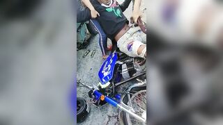 Opening The Broken Leg Of A Motorcyclist 