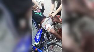 Opening The Broken Leg Of A Motorcyclist 