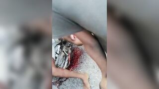 Opening The Broken Leg Of A Motorcyclist 