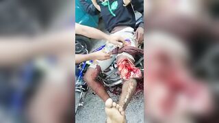 Opening The Broken Leg Of A Motorcyclist 