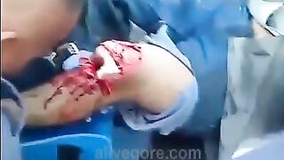 Paramedics Try To Save Injured Leg 