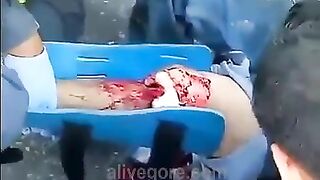 Paramedics Try To Save Injured Leg 