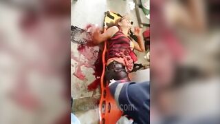 Woman's Intestines Fall Out Of Her Stomach 