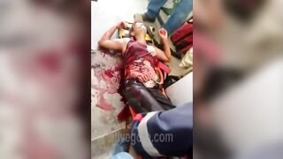 Woman's Intestines Fall Out Of Her Stomach 