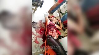 Woman's Intestines Fall Out Of Her Stomach 