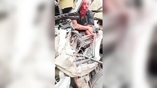 Truck Driver With Disfigured Face. Aftermath 