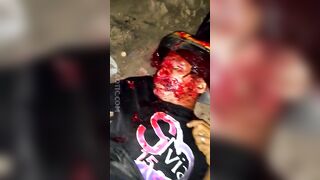 The Aftermath Of A Brutal Bicycle Accident