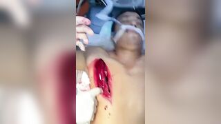 Horrible Accident While Working With A Grinding Wheel
