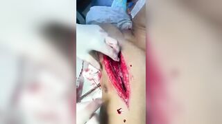 Horrible Accident While Working With A Grinding Wheel