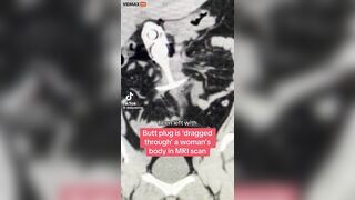 Patient With Metal Sex Toy In Butt Seriously Injured