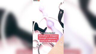 Patient With Metal Sex Toy In Butt Seriously Injured