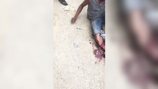 Man Shocked As He Tries To Sew His Severed Leg Back Together