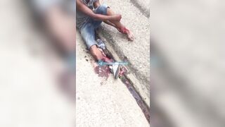 Man Shocked As He Tries To Sew His Severed Leg Back Together