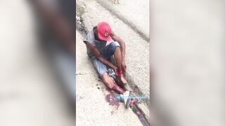 Man Shocked As He Tries To Sew His Severed Leg Back Together