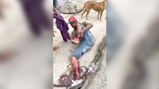 Man Tries To Sew Severed Leg Back Together