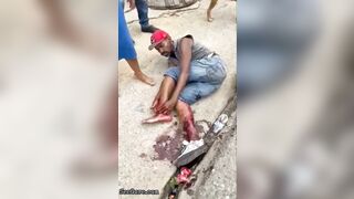 Man Tries To Sew Severed Leg Back Together